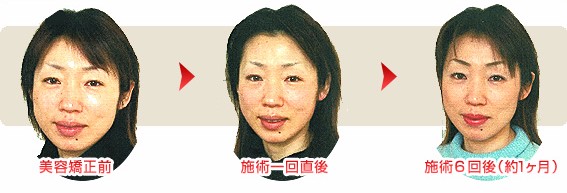 美容整体の施術例