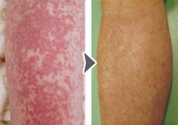 整体院で改善できる薬害・薬疹 の実例